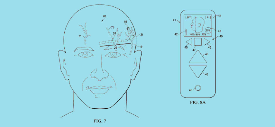 Syntilla Medical's newly patented surgical method for implantable head mounted neurostimulation system for head pain. [Images: USPTO]