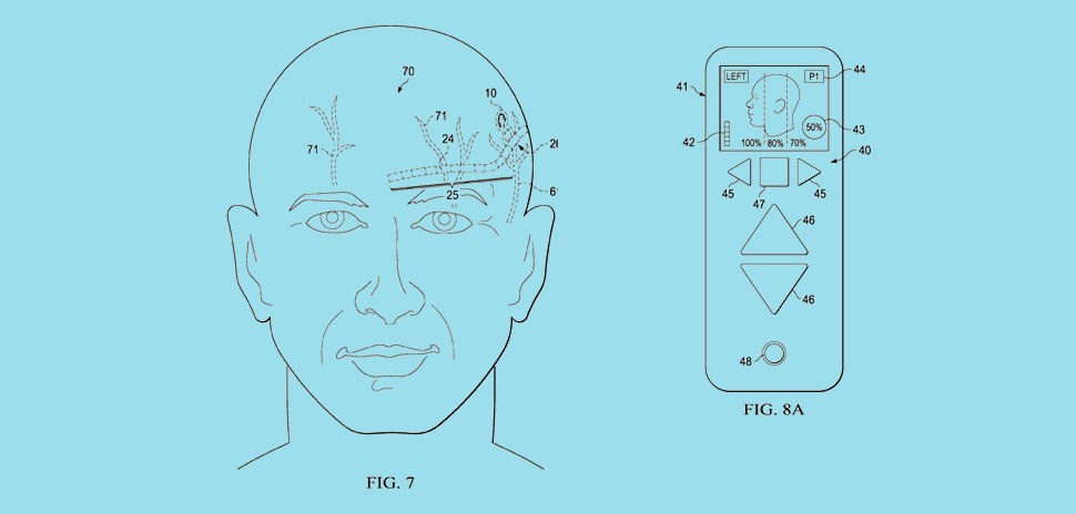 Syntilla Medical's newly patented surgical method for implantable head mounted neurostimulation system for head pain. [Images: USPTO]