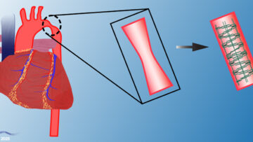 A slide showing Tremedics' award-winning technology for treating narrowed aortas in children (left). Their special dissolving stent (right) opens blocked blood vessels and then disappears as the child grows, eliminating the need for repeated surgeries and potentially helping thousands of the 40,000 U.S. babies born with heart defects annually. [Image source: Tremedics]