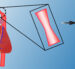 A slide showing Tremedics' award-winning technology for treating narrowed aortas in children (left). Their special dissolving stent (right) opens blocked blood vessels and then disappears as the child grows, eliminating the need for repeated surgeries and potentially helping thousands of the 40,000 U.S. babies born with heart defects annually. [Image source: Tremedics]