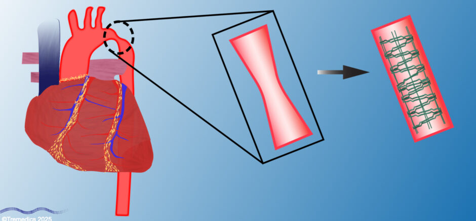 A slide showing Tremedics' award-winning technology for treating narrowed aortas in children (left). Their special dissolving stent (right) opens blocked blood vessels and then disappears as the child grows, eliminating the need for repeated surgeries and potentially helping thousands of the 40,000 U.S. babies born with heart defects annually. [Image source: Tremedics]
